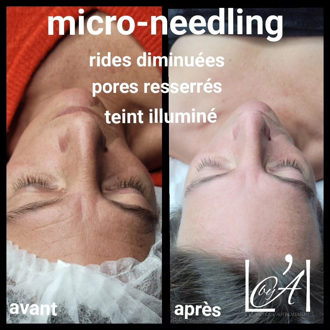 Dry microneedling teint unifié, visage femme avant/après