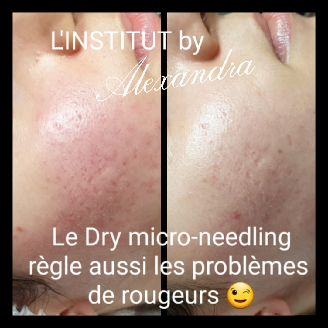 Visage femme avant/après, dry microneedling anti-rougeurs
