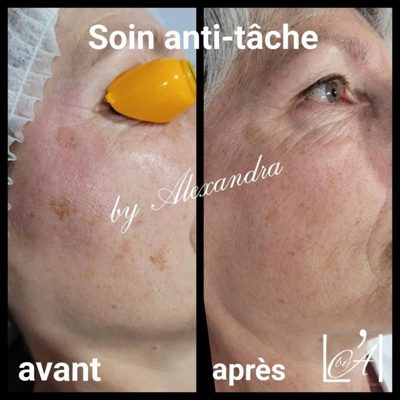 Visage femme avant/après, traitement de photorajeunissement pour les taches