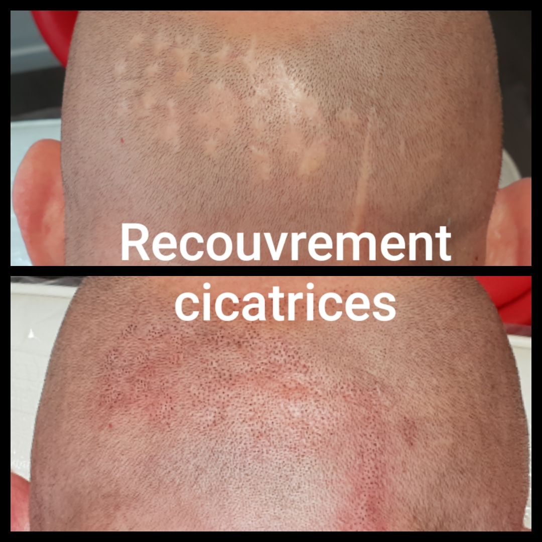 SMP homme cicatrice avant/après