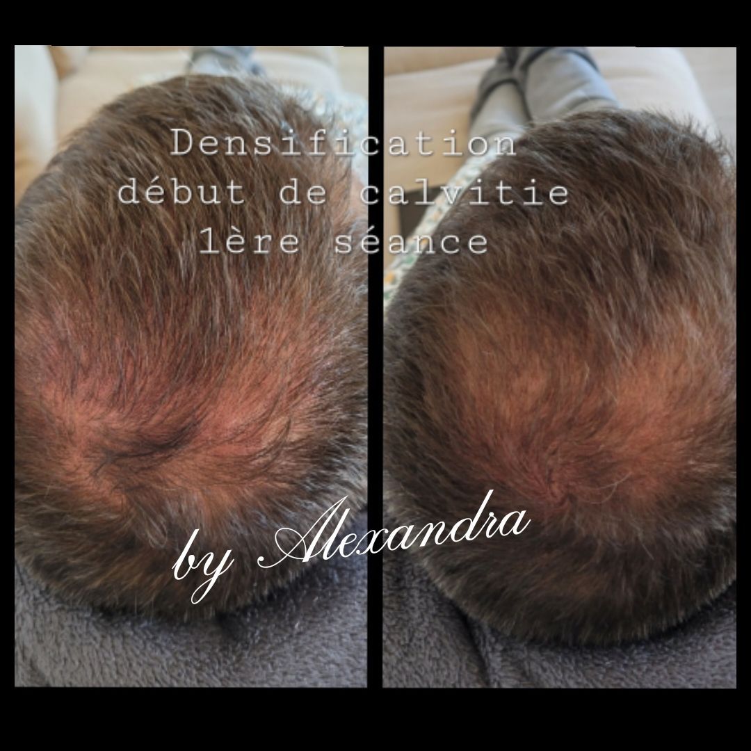 Cuir chevelu homme, avant après