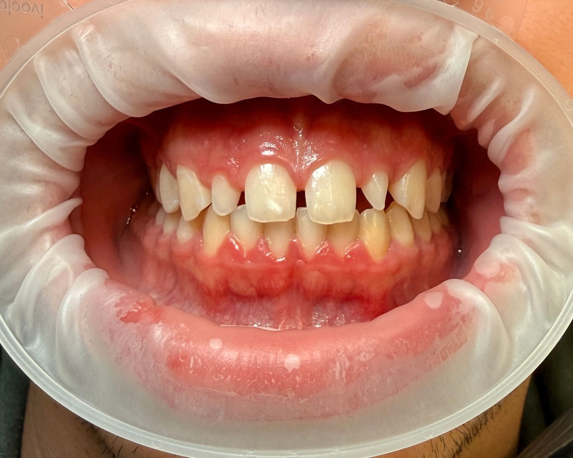 Boca con dientes y encías visibles, mostrando un espacio entre los dientes frontales. 