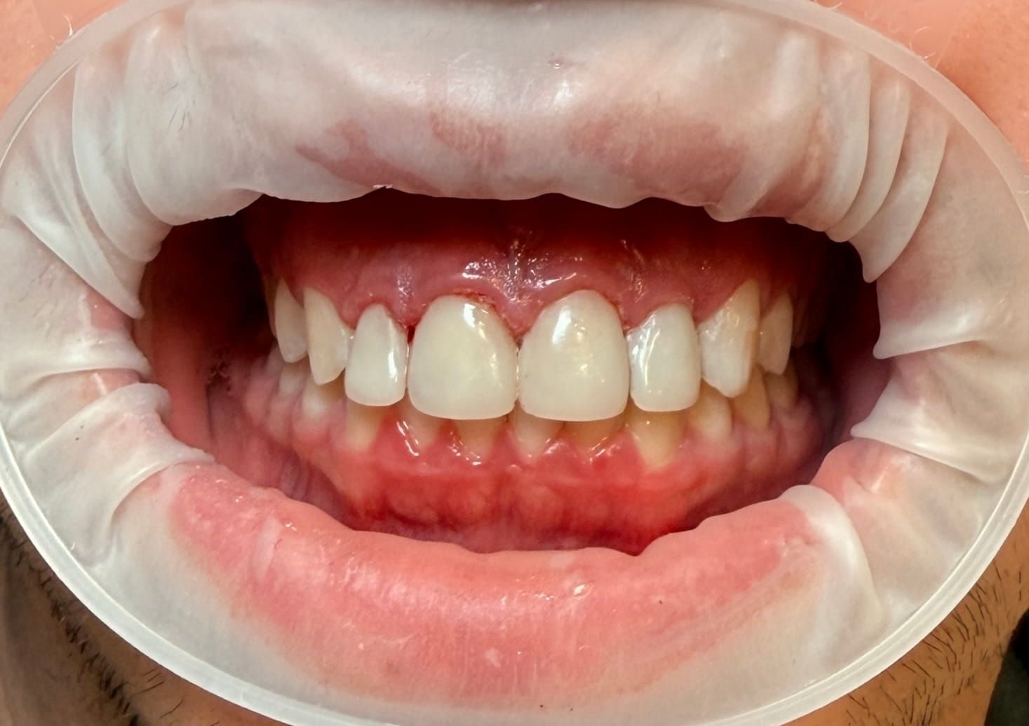 La boca abierta de una persona mostrando dientes sanos, con un retractor de mejillas en su lugar.