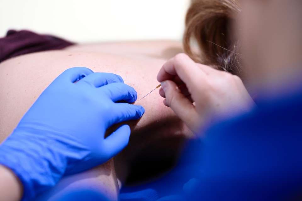 Akupunktur bei der PhysioFit Bosshard AG