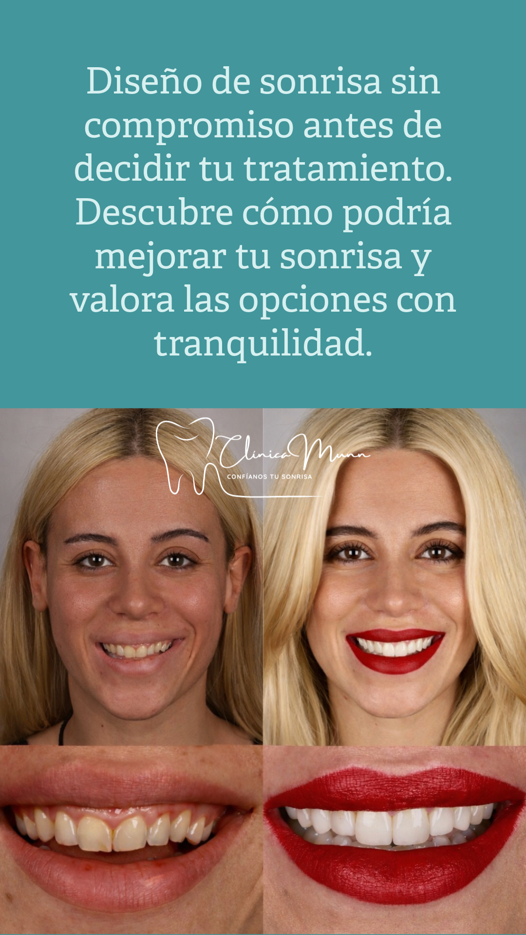 blanqueamiento dental