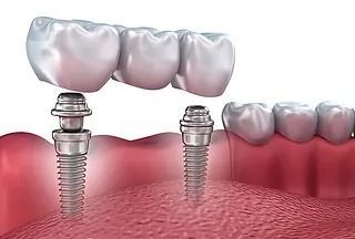 Una imagen generada por computadora de un implante dental en la boca de una persona.