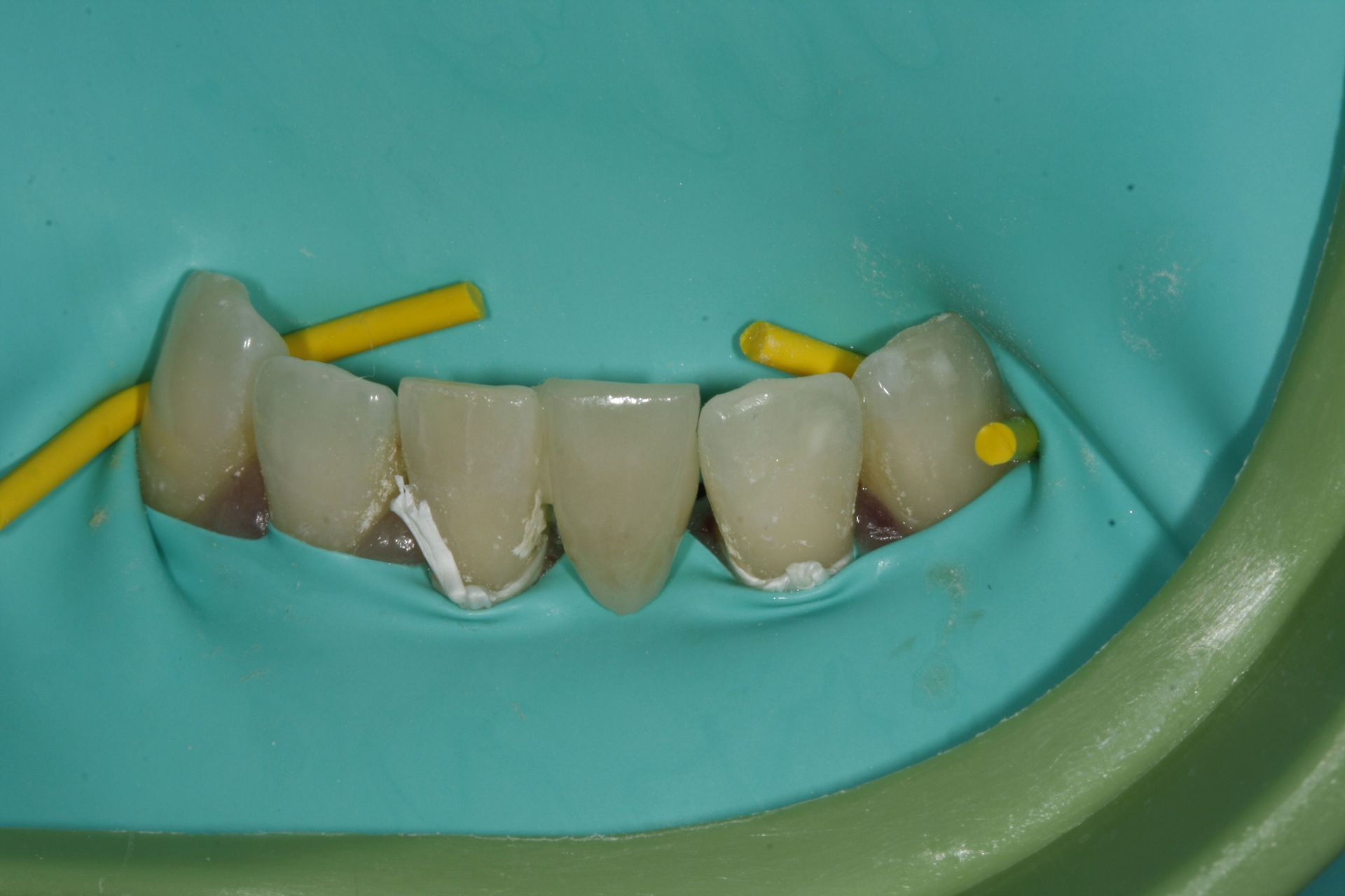 Prothèse sur mesure