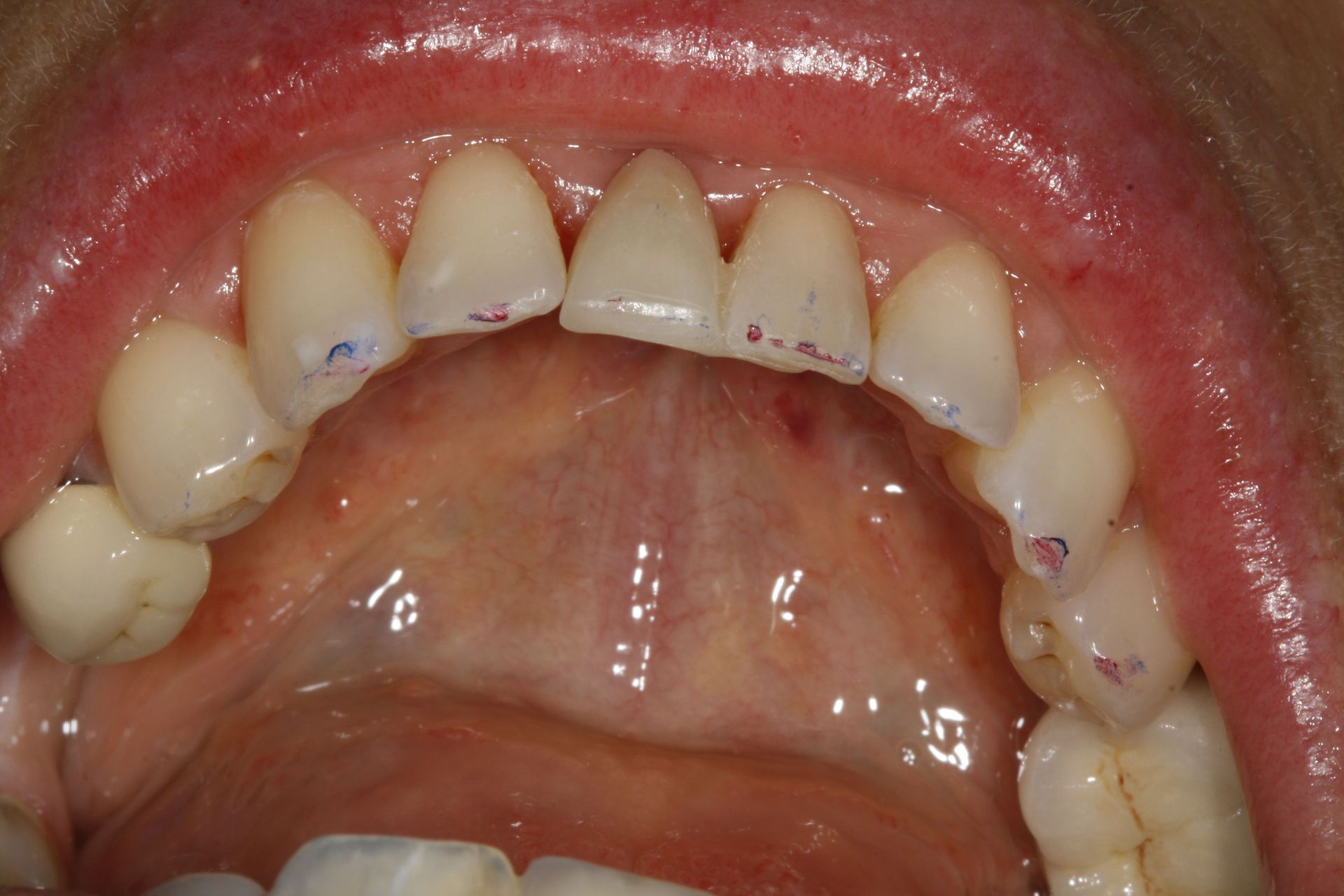 Conception de prothèse dentaire