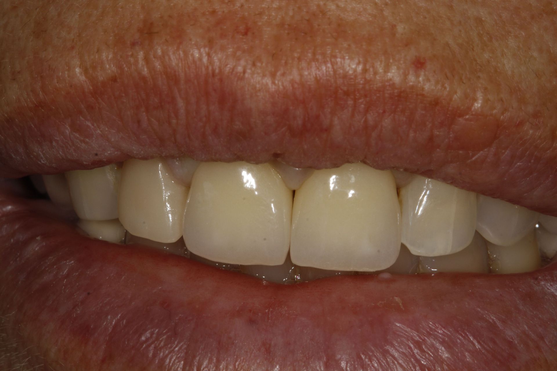 Pose de prothèse dentaire