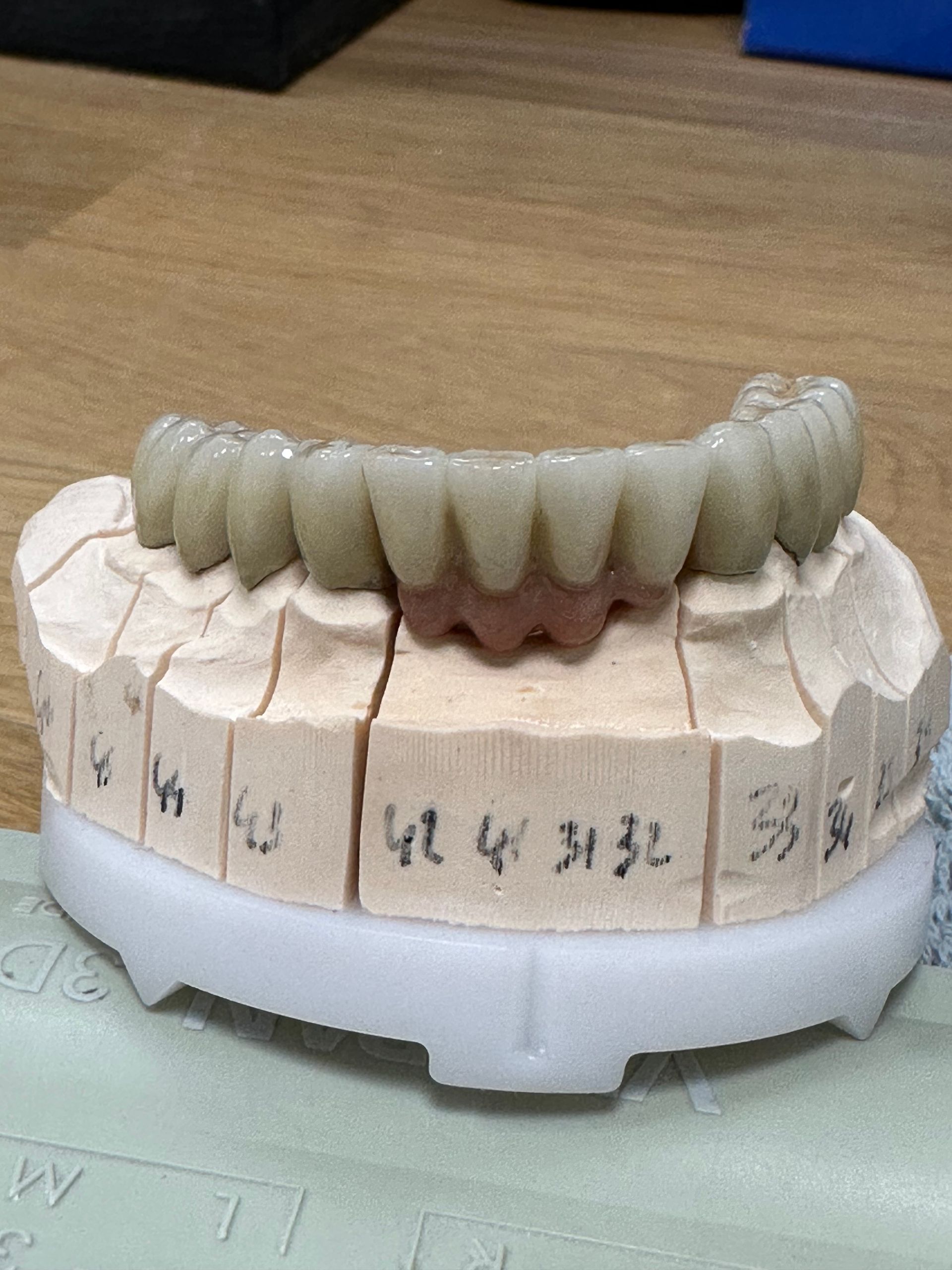 Conception sur mesure de prothèse dentaire