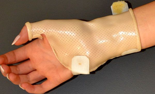 Main portant une attelle médicale beige avec sangles et rembourrage