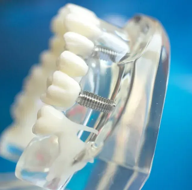 Un primer plano de un modelo dental con un tornillo en él.