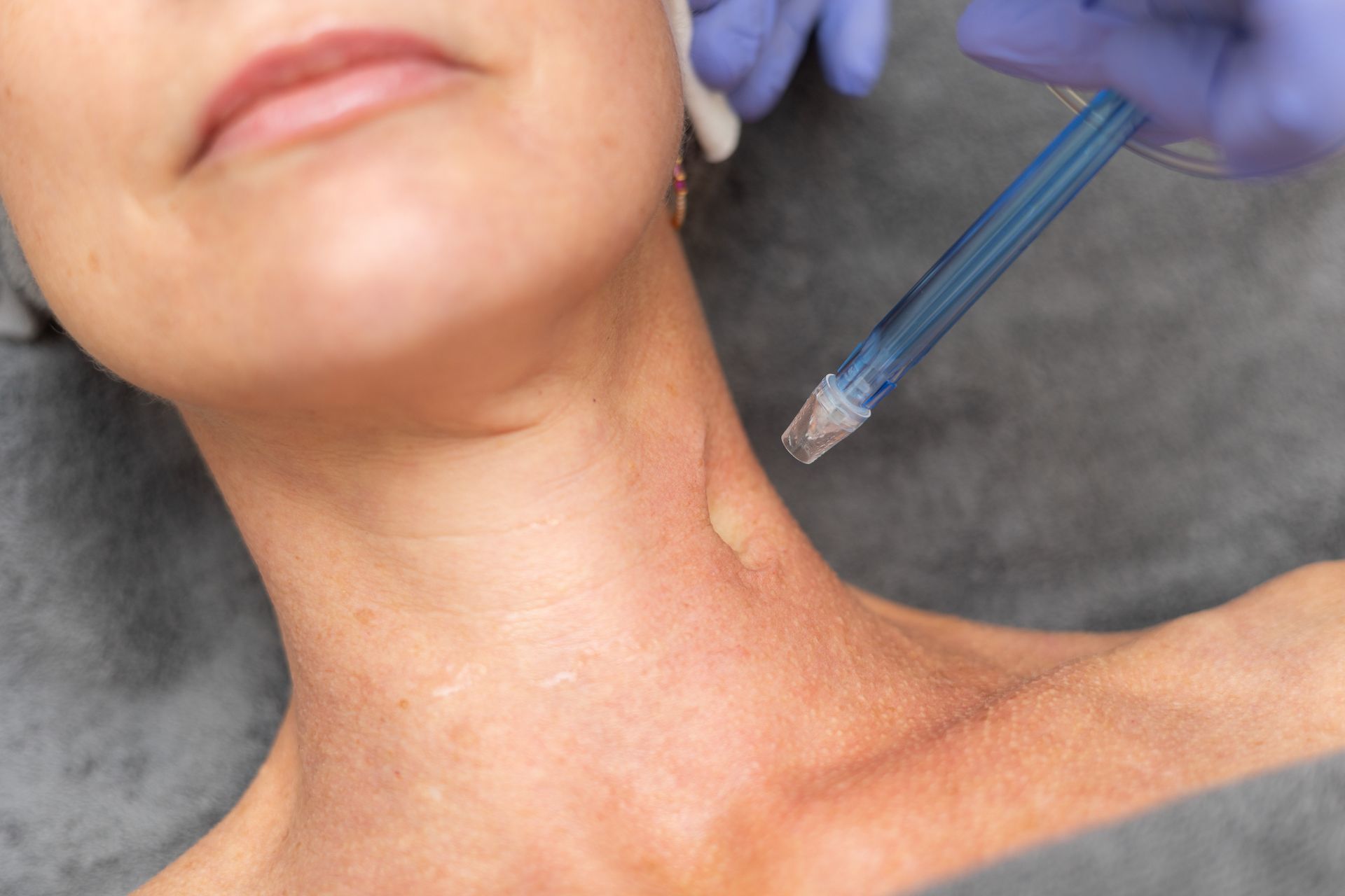 Eine Frau bekommt eine Botox-Injektion in den Nacken.