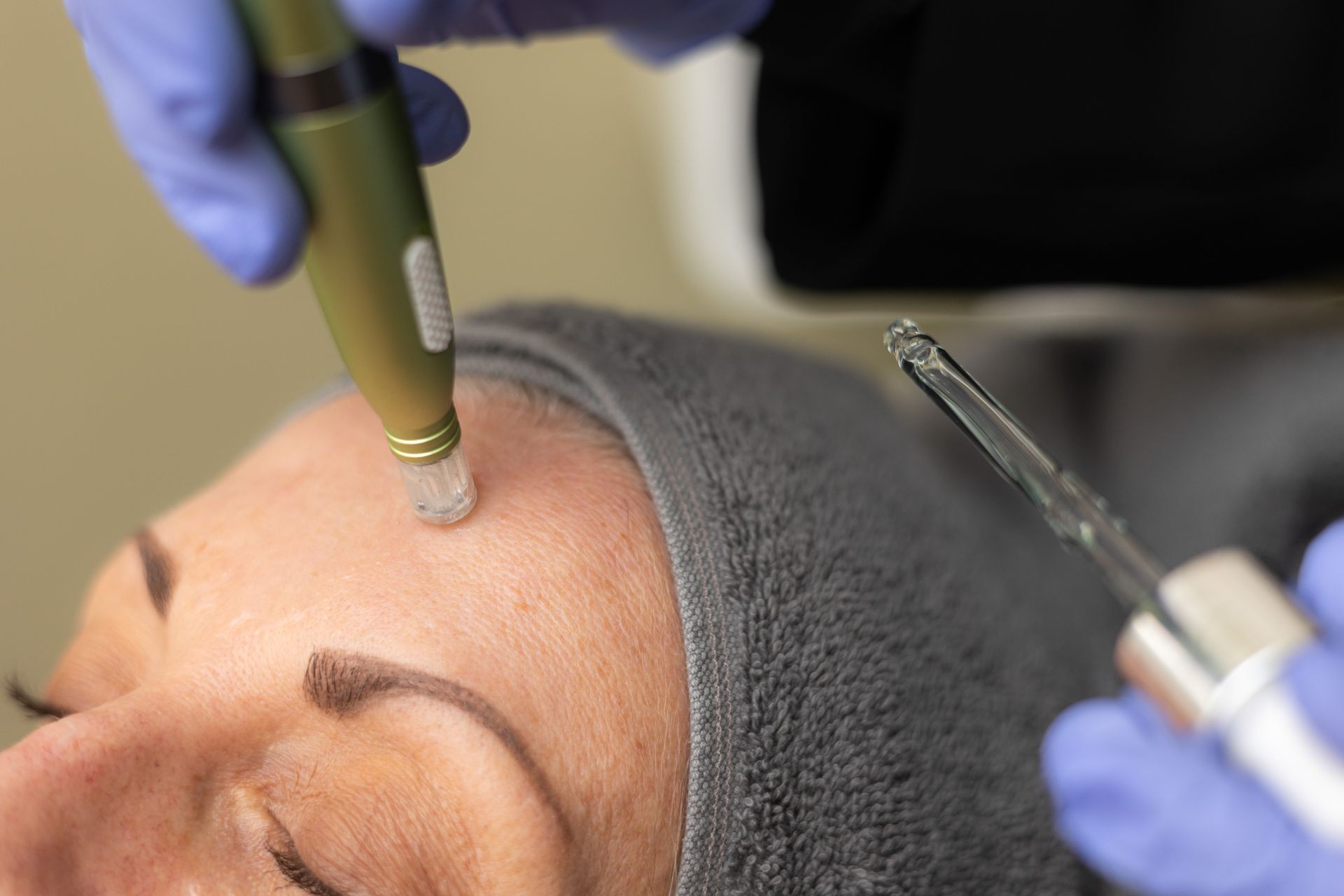 Eine Frau bekommt eine Mikrodermabrasion-Behandlung auf der Stirn.