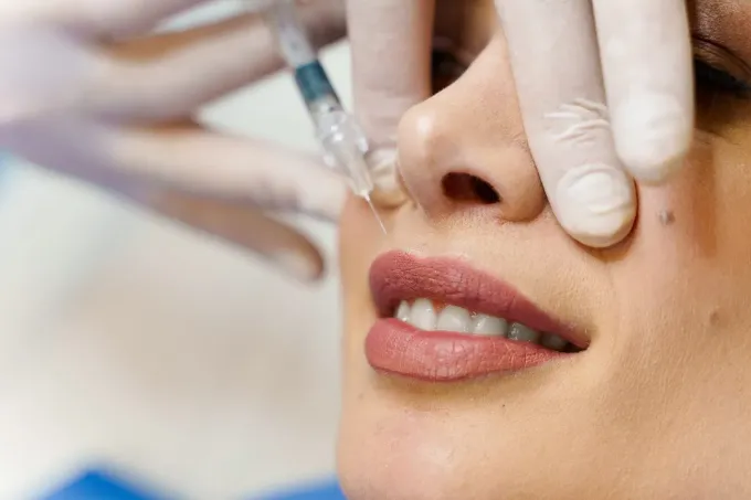 Una mano enguantada utiliza una jeringa para inyectar un relleno facial cerca de la comisura de la boca de una persona.