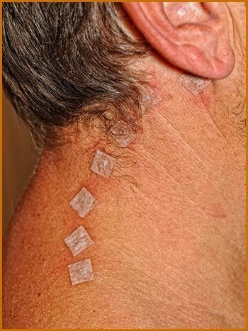 Halsfalten Akupunktur
