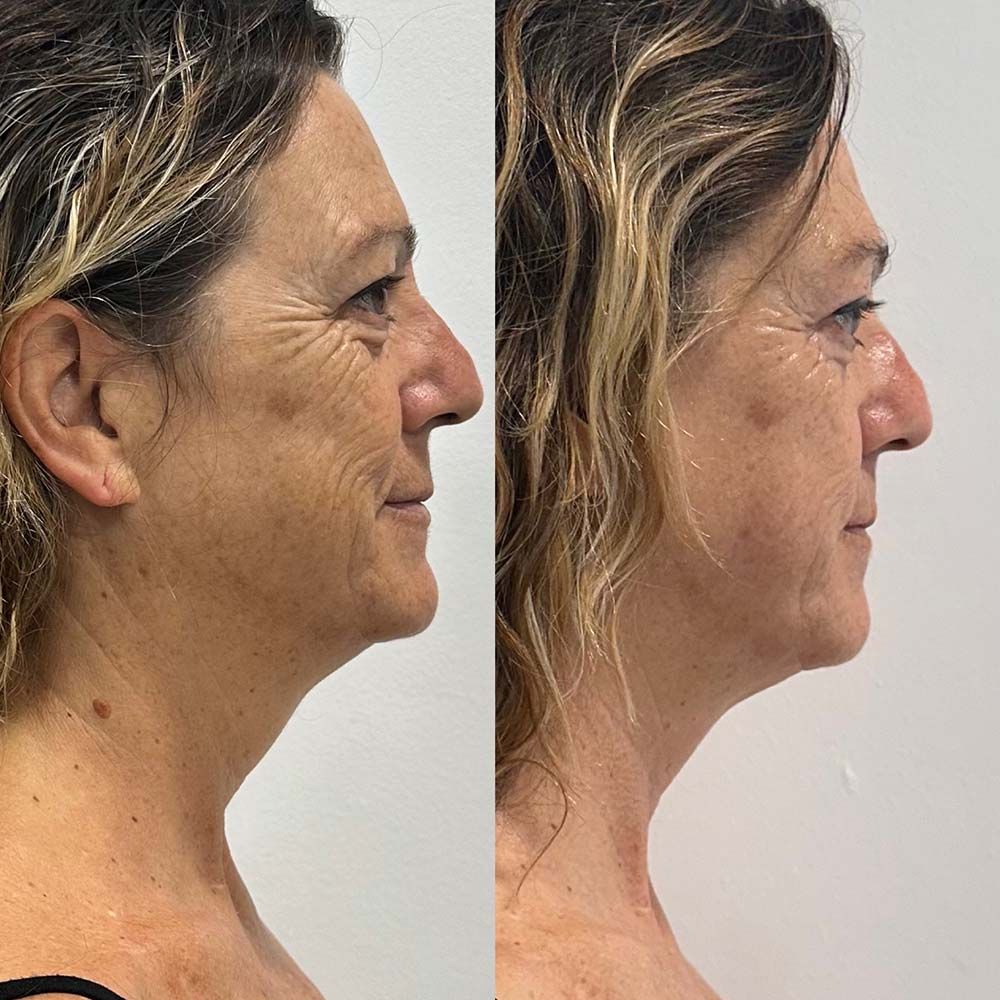 Comparación lado a lado: rostro de una mujer antes y después de un procedimiento cosmético, mostrando arrugas reducidas y piel más tensa.