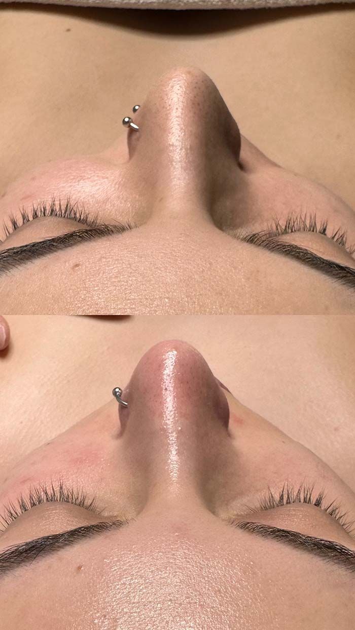 Dos fotografías que muestran una perforación en la nariz antes y después del procedimiento; piel rosada, joyas de plata.