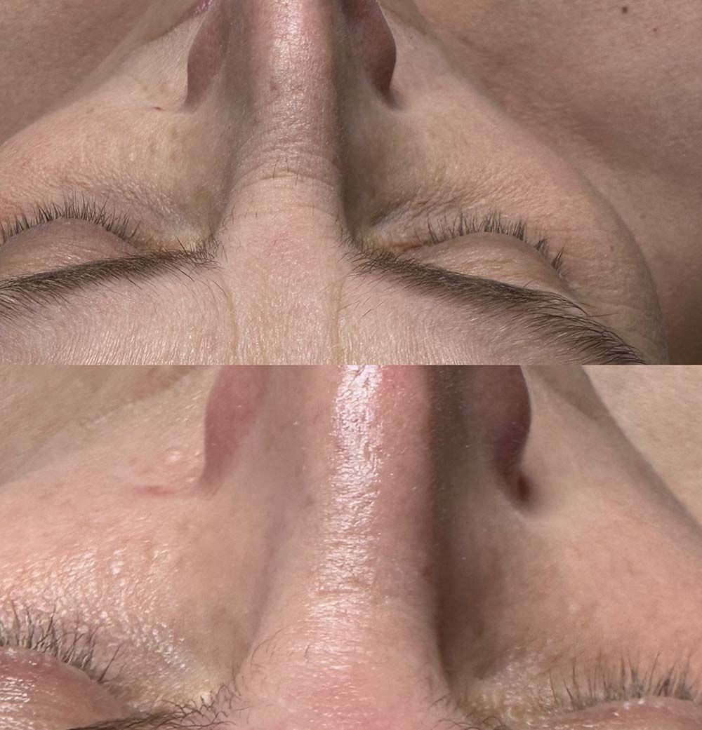 Fotografías de antes y después de la nariz y el área de los ojos de una persona, que muestran una reducción de las arrugas.