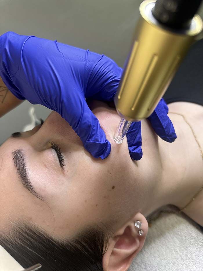 Una persona recibe un tratamiento de microagujas en el rostro. Una mano enguantada sostiene el dispositivo.