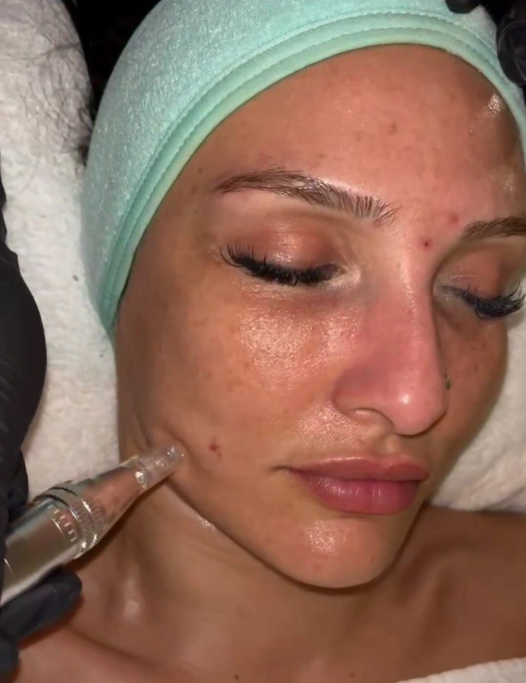 Una mujer está recibiendo un tratamiento en su cara.