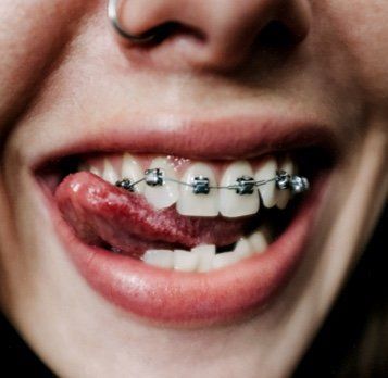 Primer plano de la boca de una persona con aparatos ortopédicos, lengua afuera y un anillo en la nariz, sonriendo.