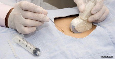 Piqûre injection